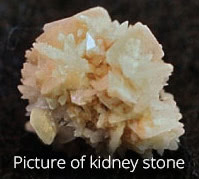 Picture of kidney stone